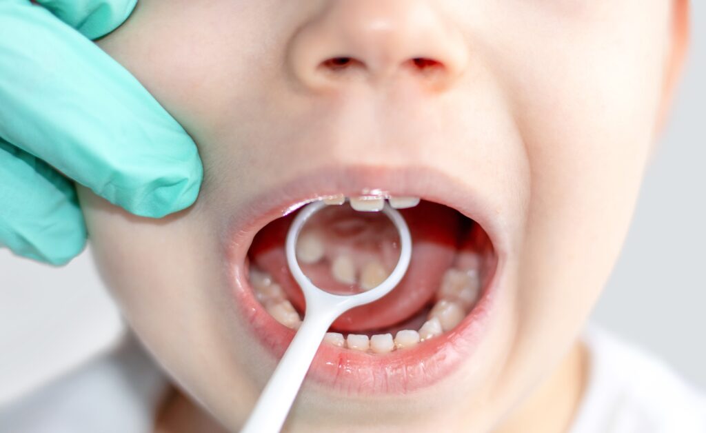 The Cavity Chain Reaction: From a Tiny Dot to Tooth Decay